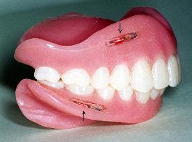 False teeth with embedded microchips receive patents